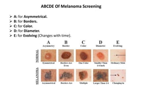 ABCDE Of Melanoma Screening
 A: for Asymmetrical.
 B: for Borders.
 C: for Color.
 D: for Diameter.
 E: for Evolving (Changes with time).
 