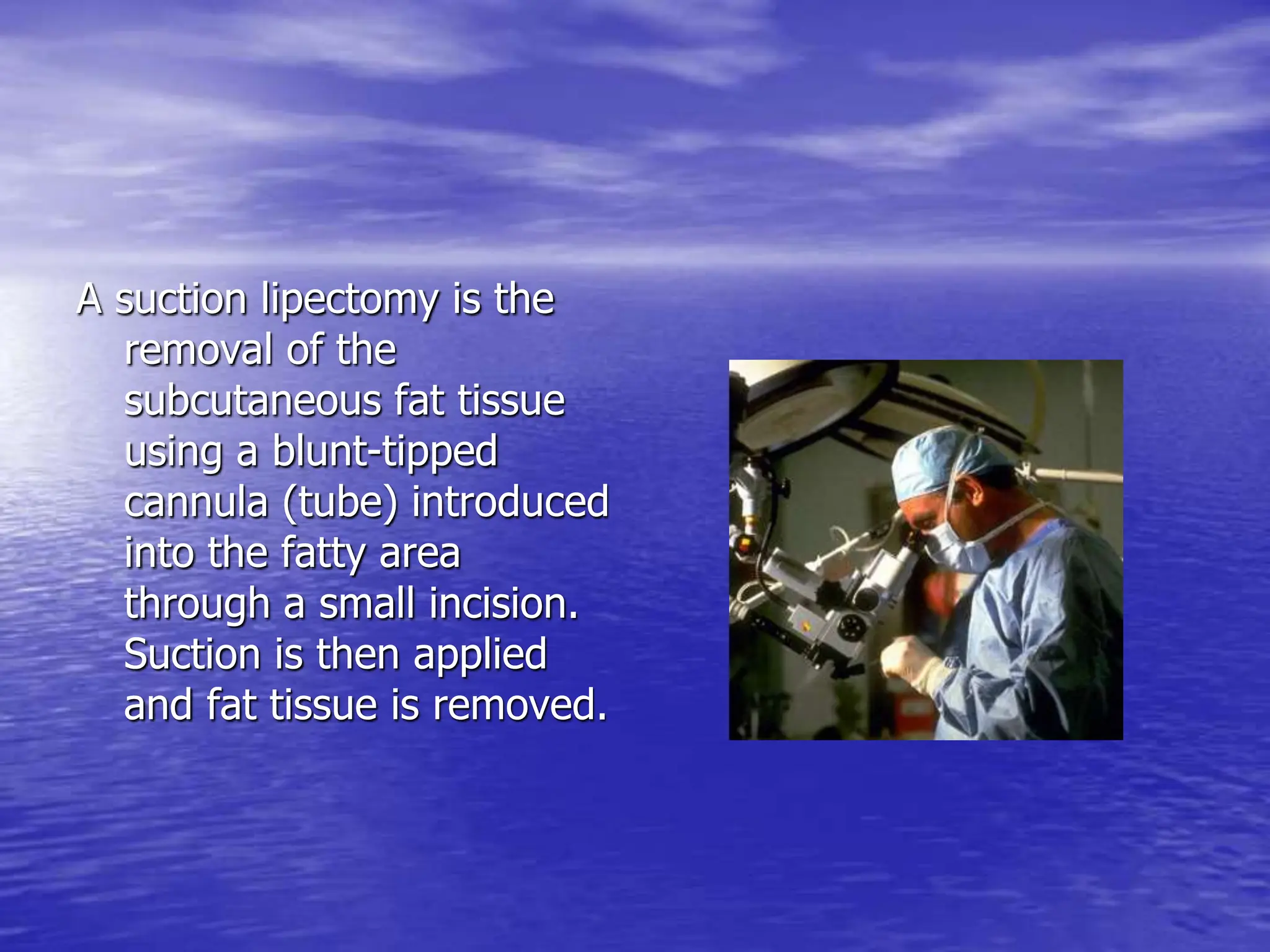 A suction lipectomy is the
removal of the
subcutaneous fat tissue
using a blunt-tipped
cannula (tube) introduced
into the fatty area
through a small incision.
Suction is then applied
and fat tissue is removed.
 