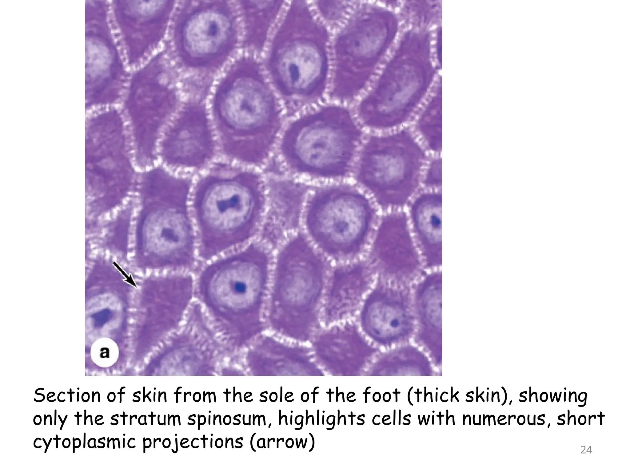 Section of skin from the sole of the foot (thick skin), showing
only the stratum spinosum, highlights cells with numerous, short
cytoplasmic projections (arrow) 24
 