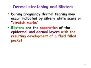 Dermal stretching and Blisters
• During pregnancy dermal tearing may
occur indicated by silvery white scars or
“stretch marks”
• Blisters are the separation of the
epidermal and dermal layers with the
resulting development of a fluid filled
pocket
52
 