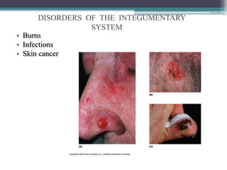 DISORDERS OF THE INTEGUMENTARY
SYSTEM
• Burns
• Infections
• Skin cancer
 