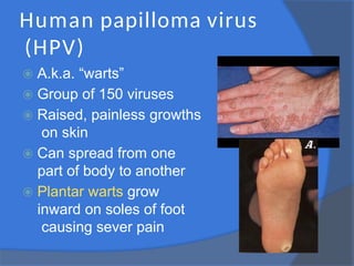 Human papilloma virus
(HPV)
⦿ A.k.a. “warts”
⦿ Group of 150 viruses
⦿ Raised, painless growths
on skin
⦿ Can spread from one
part of body to another
⦿ Plantar warts grow
inward on soles of foot
causing sever pain
 