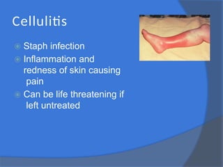 Cellulitis
⦿ Staph infection
⦿ Inflammation and
redness of skin causing
pain
⦿ Can be life threatening if
left untreated
 