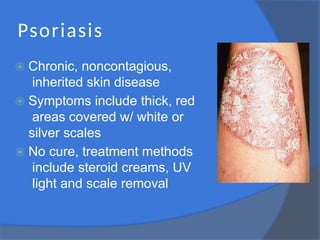 Psoriasis
⦿ Chronic, noncontagious,
inherited skin disease
⦿ Symptoms include thick, red
areas covered w/ white or
silver scales
⦿ No cure, treatment methods
include steroid creams, UV
light and scale removal
 