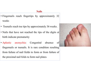 Nails
• Fingernails reach fingertips by approximately 32
weeks
• Toenails reach toe tips by approximately 36 weeks.
• Nails that have not reached the tips of the digits at
birth indicate prematurity
• Aplastic anonychia: Congenital absence of
fingernails or toenails. It is rare condition resulting
from failure of nail fields to form or from failure of
the proximal nail folds to form nail plates
 