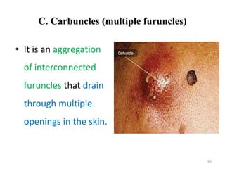 Carbuncle Example Integumentary System for midwife.pptx