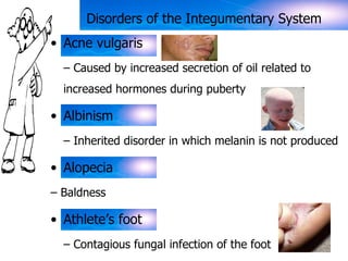 Disorders of the Integumentary System 
• Acne vulgaris 
– Caused by increased secretion of oil related to 
increased hormones during puberty 
• Albinism 
– Inherited disorder in which melanin is not produced 
• Alopecia 
– Baldness 
• Athlete’s foot 
– Contagious fungal infection of the foot 
 
