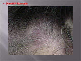 • Dandruff Example:
 