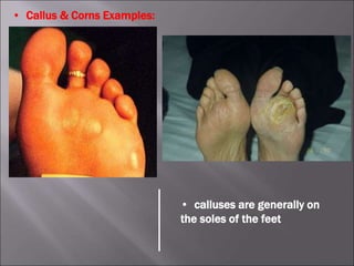 • Callus & Corns Examples:
• calluses are generally on
the soles of the feet
 