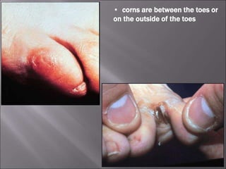 • corns are between the toes or
on the outside of the toes
 