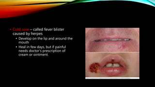 • Cold sore – called fever blister
caused by herpes
• Develop on the lip and around the
mouth
• Heal in few days, but if painful
needs doctor’s prescription of
cream or ointment.
 