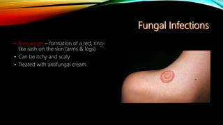 • Ring worm – formation of a red, ring-
like rash on the skin (arms & legs)
• Can be itchy and scaly
• Treated with antifungal cream
 