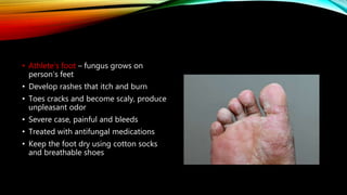 • Athlete’s foot – fungus grows on
person’s feet
• Develop rashes that itch and burn
• Toes cracks and become scaly, produce
unpleasant odor
• Severe case, painful and bleeds
• Treated with antifungal medications
• Keep the foot dry using cotton socks
and breathable shoes
 