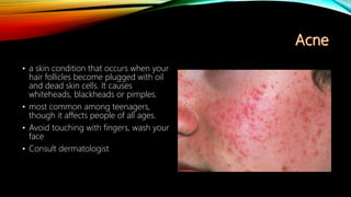 • a skin condition that occurs when your
hair follicles become plugged with oil
and dead skin cells. It causes
whiteheads, blackheads or pimples.
• most common among teenagers,
though it affects people of all ages.
• Avoid touching with fingers, wash your
face
• Consult dermatologist
 