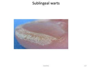 Sublingeal warts 
HA(MSN) 137 
 