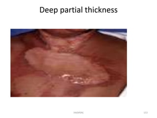 Deep partial thickness 
HA(MSN) 153 
 