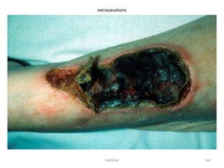 extravasations 
HA(MSN) 160 
 
