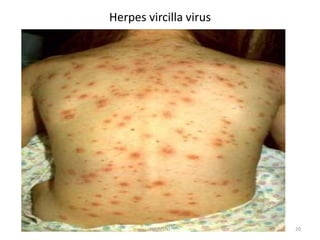 Herpes vircilla virus 
HA(MSN) 20 
 