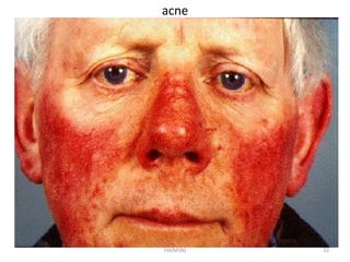 acne 
HA(MSN) 22 
 