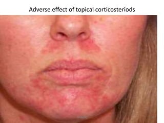 Adverse effect of topical corticosteriods 
HA(MSN) 23 
 