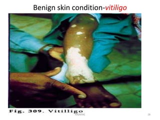 Benign skin condition-vitiligo 
HA(MSN) 28 
 