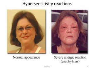 Hypersensitivity reactions 
HA(MSN) 41 
 