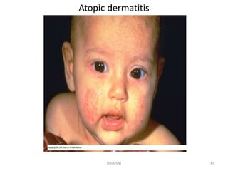 Atopic dermatitis 
HA(MSN) 45 
 