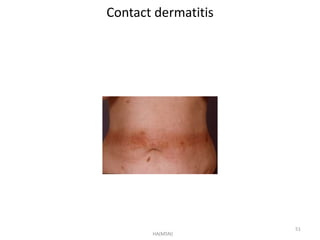 Contact dermatitis 
HA(MSN) 
51 
 