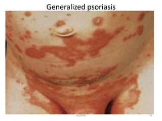 Generalized psoriasis 
HA(MSN) 65 
 