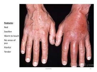 HA(MSN) 70 
Features: 
Red 
Swollen 
Warm to touch 
No areas of 
pus 
Painful 
Tender 
 