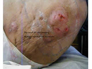 The result of “skin popping” - 
Multiple injection site abscesses 
HA(MSN) 75 
 