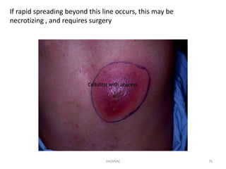 If rapid spreading beyond this line occurs, this may be 
necrotizing , and requires surgery 
Cellulitis with abscess 
HA(MSN) 76 
 