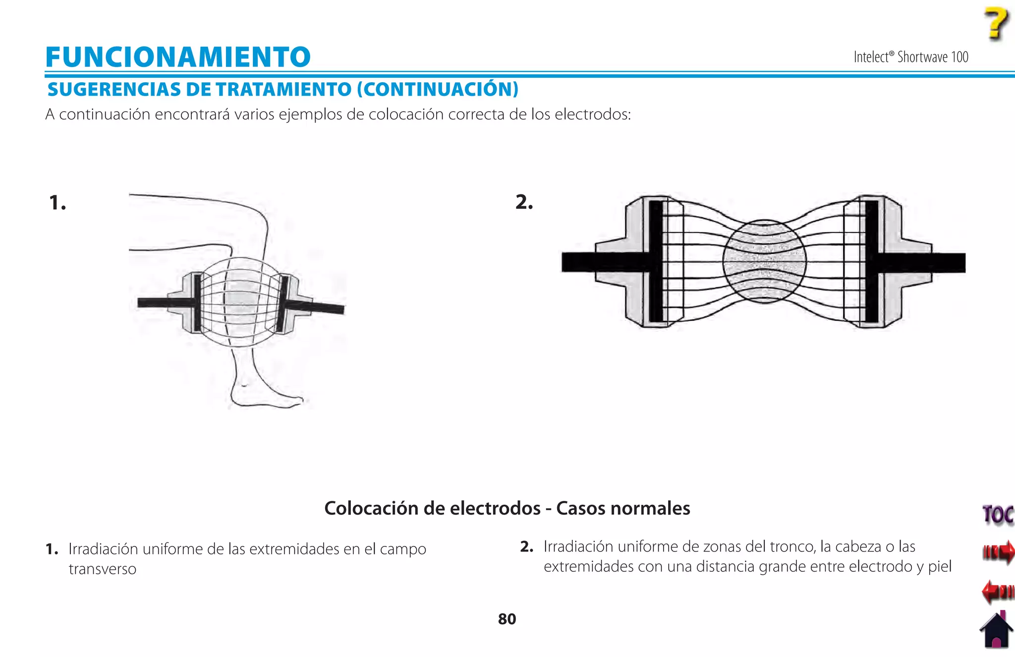 FUNCIONAMIENTO                                                                                                       Intelect® Shortwave 100

SUGERENCIAS DE TRATAMIENTO CONTINUACIÓN
A continuación encontrará varios ejemplos de colocación correcta de los electrodos:




1.                                                                2.




                                        Colocación de electrodos - Casos normales
1. Irradiación uniforme de las extremidades en el campo              2. Irradiación uniforme de zonas del tronco, la cabeza o las
   transverso                                                           extremidades con una distancia grande entre electrodo y piel


                                                                80
 