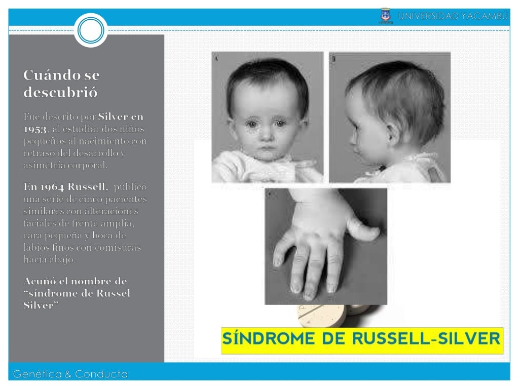 Sindrome Russell Silver; Síndrome Cri du