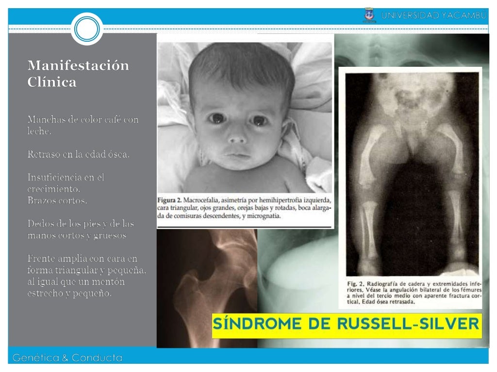 Sindrome Russell Silver; Síndrome Cri du