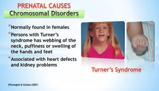 *Normally found in females
*Persons with Turner’s
syndrome has webbing of the
neck, puffiness or swelling of
the hands and feet
*Associated with heart defects
and kidney problems
Turner’s Syndrome
PRENATAL CAUSES
(Pierangelo & Giuliani,2007)
 