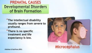 *The intellectual disability
usually ranges from severe to
profound.
*There is no specific
treatment and life
expectancy is low.
Microcephalus
PRENATAL CAUSES
(Hallahan & Kauffman,2003)
 