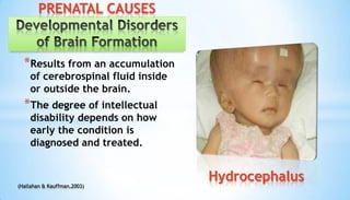 *Results from an accumulation
of cerebrospinal fluid inside
or outside the brain.
*The degree of intellectual
disability depends on how
early the condition is
diagnosed and treated.
Hydrocephalus
PRENATAL CAUSES
(Hallahan & Kauffman,2003)
 