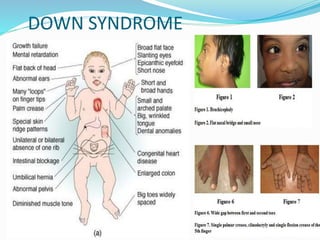 DOWN SYNDROME
 