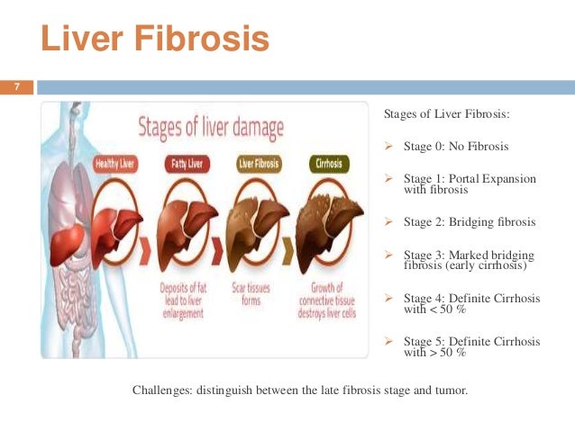 early cirrhosis