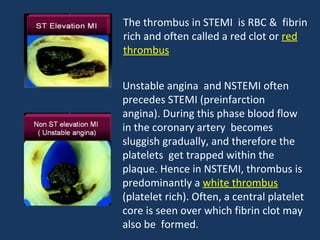 The thrombus in STEMI is RBC & fibrin
rich and often called a red clot or red
thrombus


Unstable angina and NSTEMI often
precedes STEMI (preinfarction
angina). During this phase blood flow
in the coronary artery becomes
sluggish gradually, and therefore the
platelets get trapped within the
plaque. Hence in NSTEMI, thrombus is
predominantly a white thrombus
(platelet rich). Often, a central platelet
core is seen over which fibrin clot may
also be formed.
 