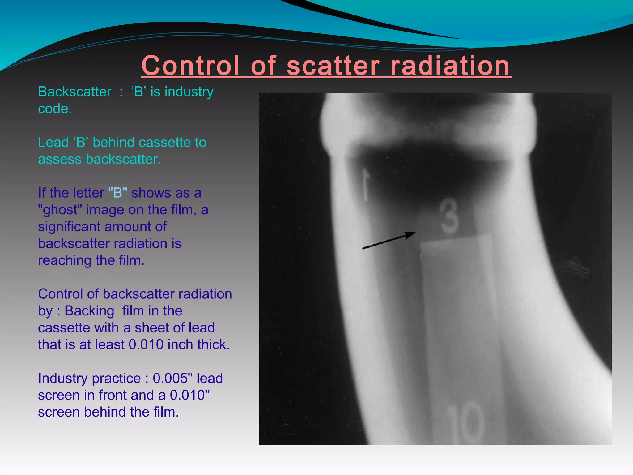Control of scatter radiation
Backscatter : ‘B’ is industry
code.
Lead ‘B’ behind cassette to
assess backscatter.
If the letter "B" shows as a
"ghost" image on the film, a
significant amount of
backscatter radiation is
reaching the film.
Control of backscatter radiation
by : Backing film in the
cassette with a sheet of lead
that is at least 0.010 inch thick.
Industry practice : 0.005" lead
screen in front and a 0.010"
screen behind the film.
 