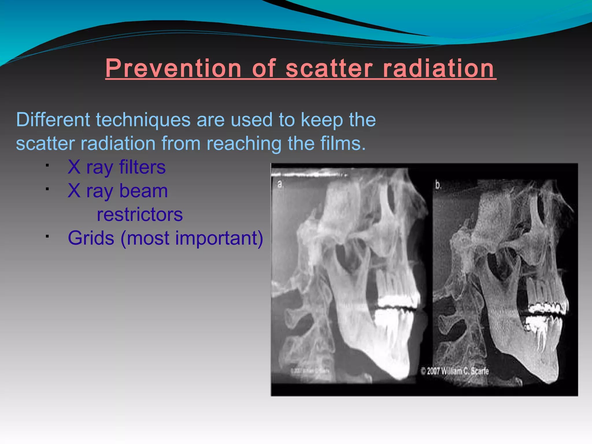 Different techniques are used to keep the
scatter radiation from reaching the films.
§
X ray filters
§
X ray beam
restrictors
§
Grids (most important)
Prevention of scatter radiation
 