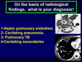 On the basis of radiological
findings, what is your diagnosis

1-Septic pulmonary embolism.
2- Cavitating pneumonia.
3- Pulmonary TB
4-Cavitating secondaries

 