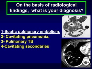 On the basis of radiological
findings, what is your diagnosis

1-Septic pulmonary embolism.
2- Cavitating pneumonia.
3- Pulmonary TB
4-Cavitating secondaries

 