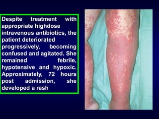 Despite treatment with
appropriate highdose
intravenous antibiotics, the
patient deteriorated
progressively,
becoming
confused and agitated. She
remained
febrile,
hypotensive and hypoxic.
Approximately, 72 hours
post
admission,
she
developed a rash

 