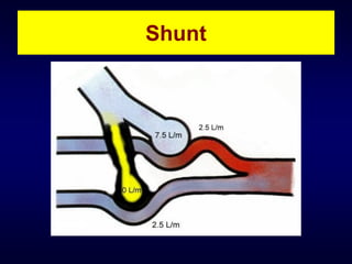 Shunt

 