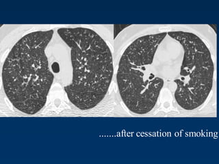 .......after cessation of smoking
 