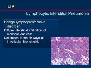 Benign lymphoproliferative
disorder
Diffuse interstitial infiltration of
mononuclear cells
Not limited to the air ways as
in follicular Bronchiolitis
LIP
= Lymphocytic Interstitial Pneumonia
 