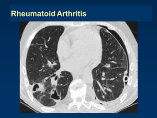 Rheumatoid Arthritis
 